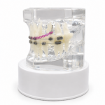Maqueta Dental Transparente de Ortodoncia con Brackets y Microtornillos
